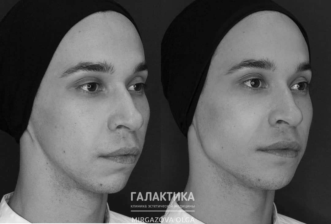 Результат контурной пластики препаратом Neauvia MAN