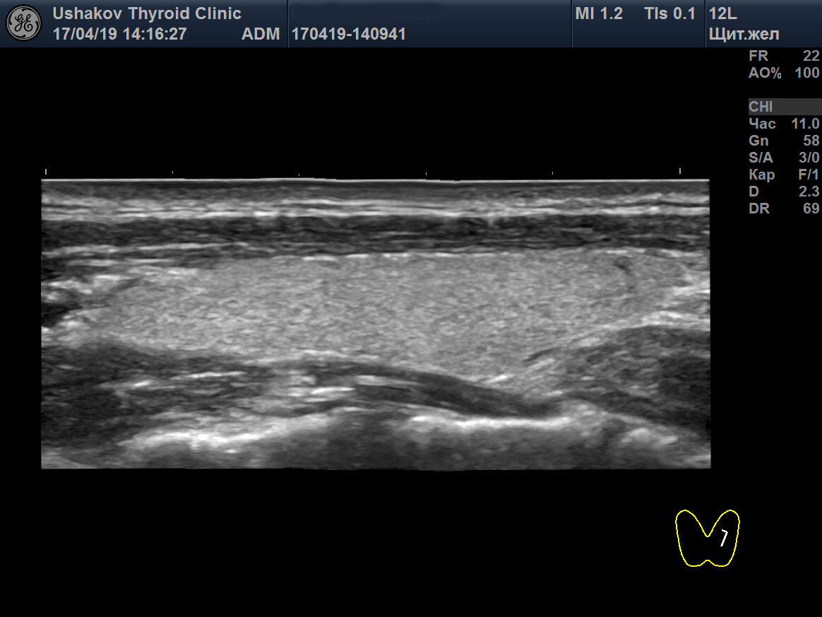 Узи железы. УЗИ, узел левой доли щитовидной железы .ti-rads 4a. Сонограмма щитовидной железы в норме. Добавочная доля щитовидной железы на УЗИ. Пирамидальная доля щитовидной железы на УЗИ.
