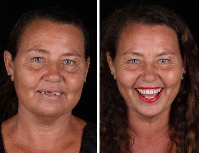 До и после зубного протезирования