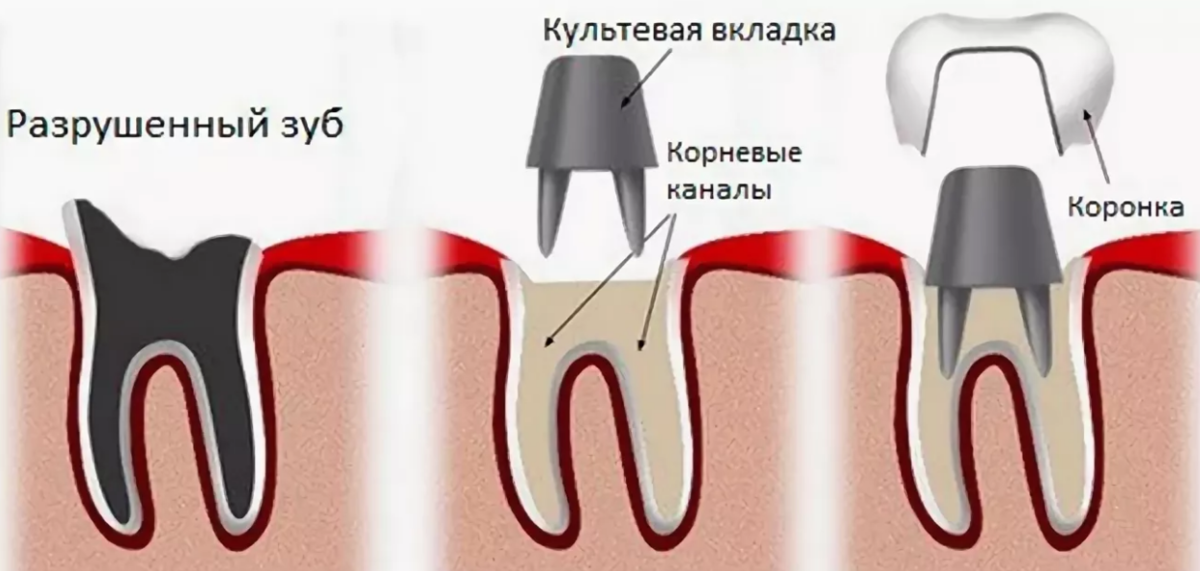 Восстановление культи. Штифтовая культевая вкладка. Культевая вкладка кариес. Культевая вкладка под коронку. Культевая вкладка рентген.