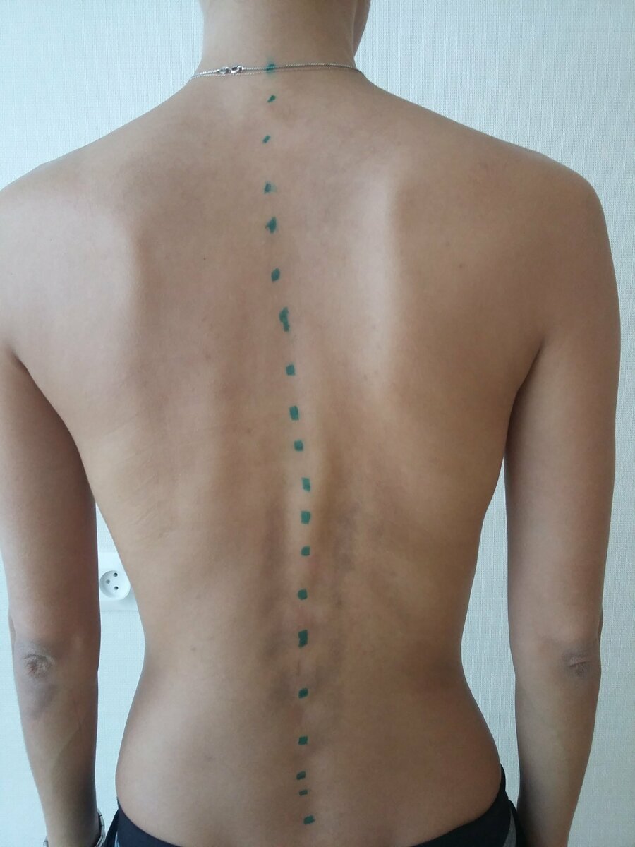 Тут видно что средние позвонки смещены влево.