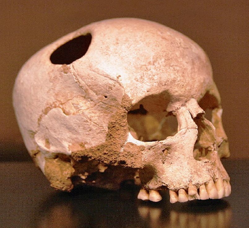 череп девочки, перенесшей трепанацию. Музей истории Лозанны