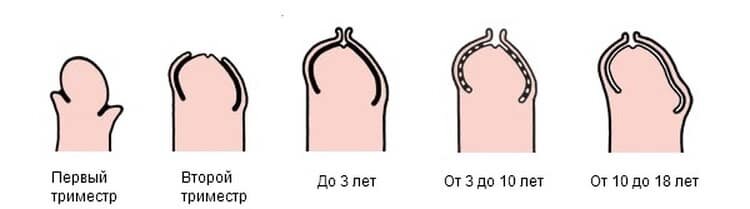 Фимоз (сужение крайней плоти) – причины, симптомы заболевания, диагностика и лечение в Москве