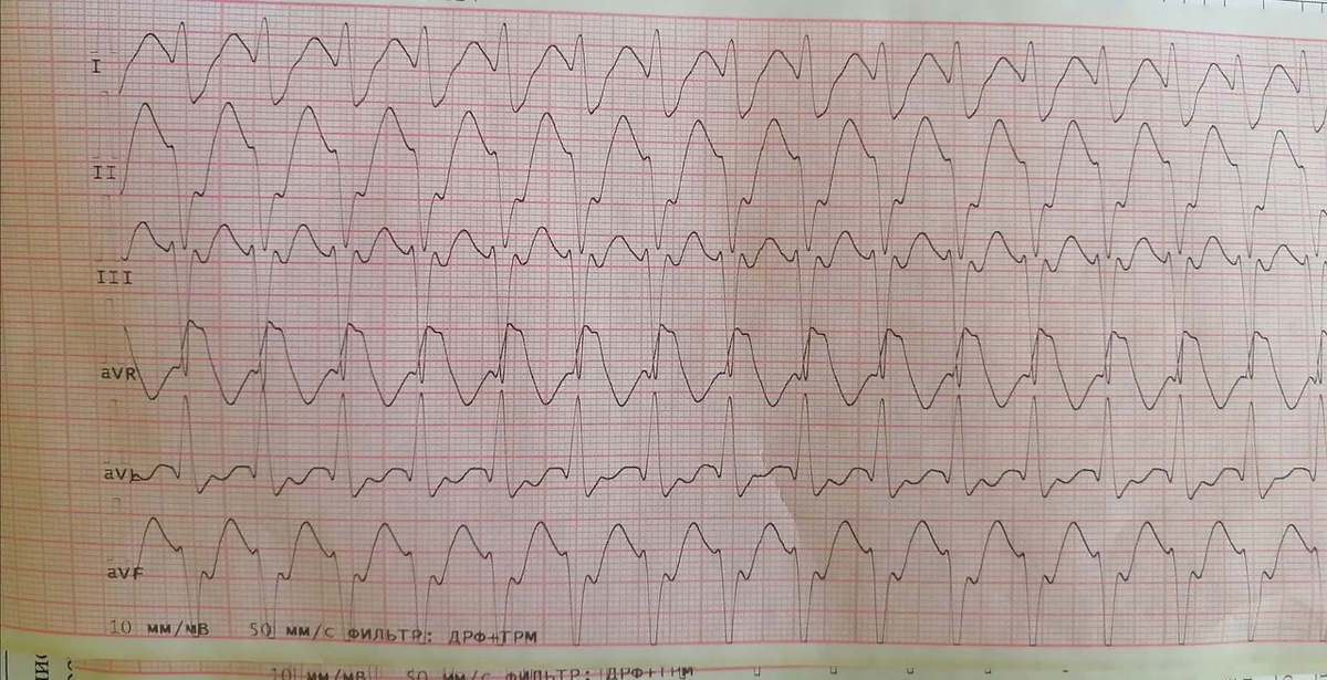 ЭКГ пациента, м,31 год.Пароксизмальная наджелудочковая тахикардия с WPW - синдромом.