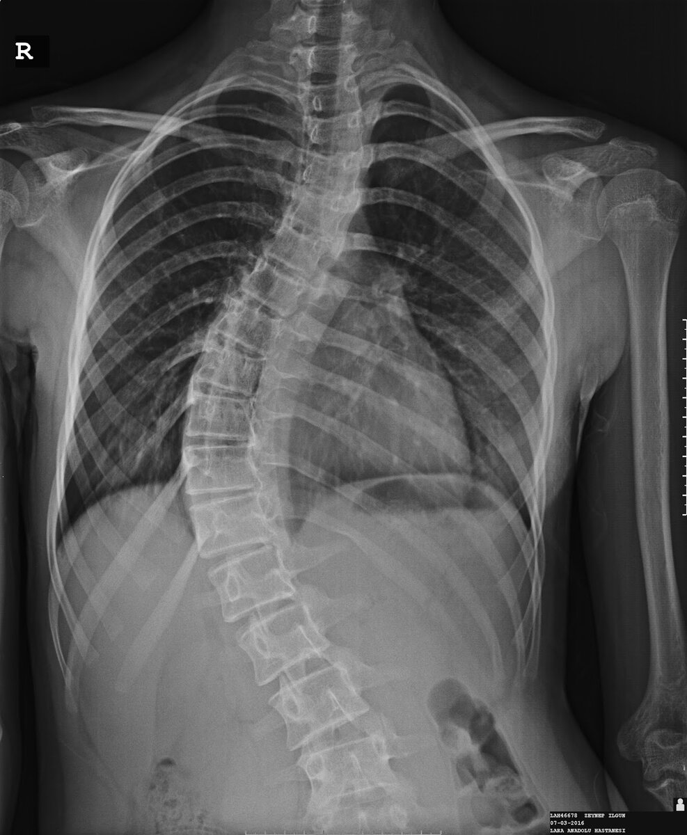 Кифосколиоз мкб. Сколиоз 2 степени рентген. Сколиоз 3 СТЕПЕНИР енген. Сколиоз 3 степени рентген.