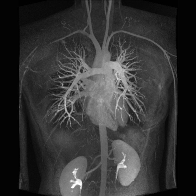 Кт сердца с контрастированием. Магнитно-резонансная томография (мрт) сердца. Магнитно-резонансная ангиография сердца. Мультиспиральная кт сердца сосудов сердца. Компьютерная томография (кт) сердца.