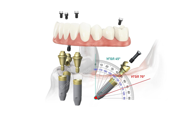 Нельзя устанавливать импланты больше чем под углом 45° – имплант тогда будет буквально лежать. Это не увеличит площадь контакта с костью, а приведет к перегрузке всей системы. Фото: Smile-at-Once.