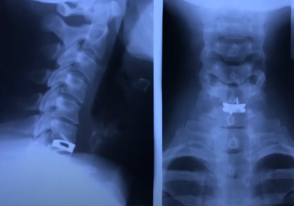 Стабилизация кейджем с 2 винтами