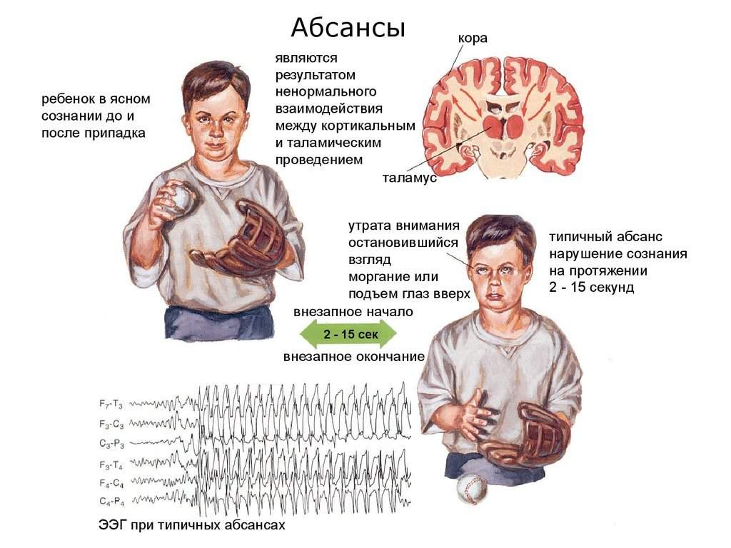 Малые припадки. Абсанс эпилепсия симптомы. Абсанс малый приступ эпилептический. Абсанс у детей симптомы. Эпилепсия (генерализованная форма, абсанс).