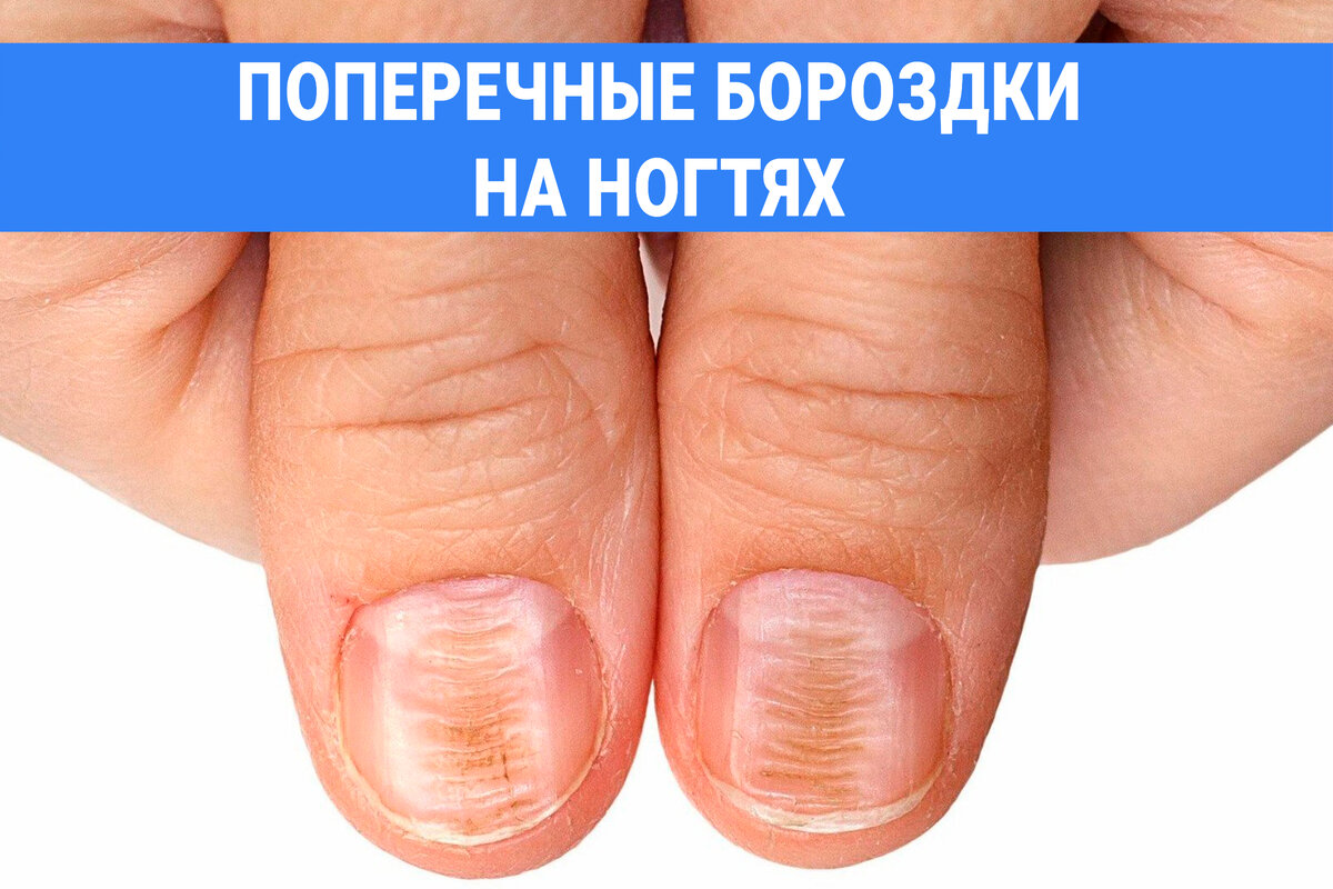 Почему на ногтях появляются продольные