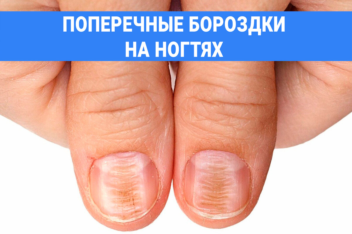 Поперечные борозды на ногтях.