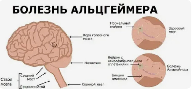 Головной мозг у пожилых. Болезнь Альцгеймера. Болезнь Альцгеймера причины. Симптомы при болезни Альцгеймера. Причины заболевания Альцгеймера.