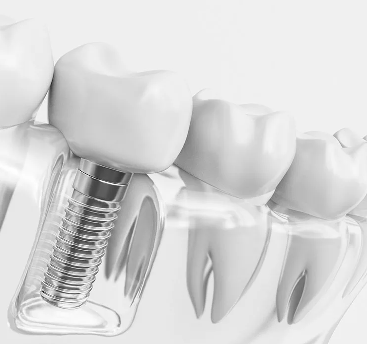 Имплантация зубов