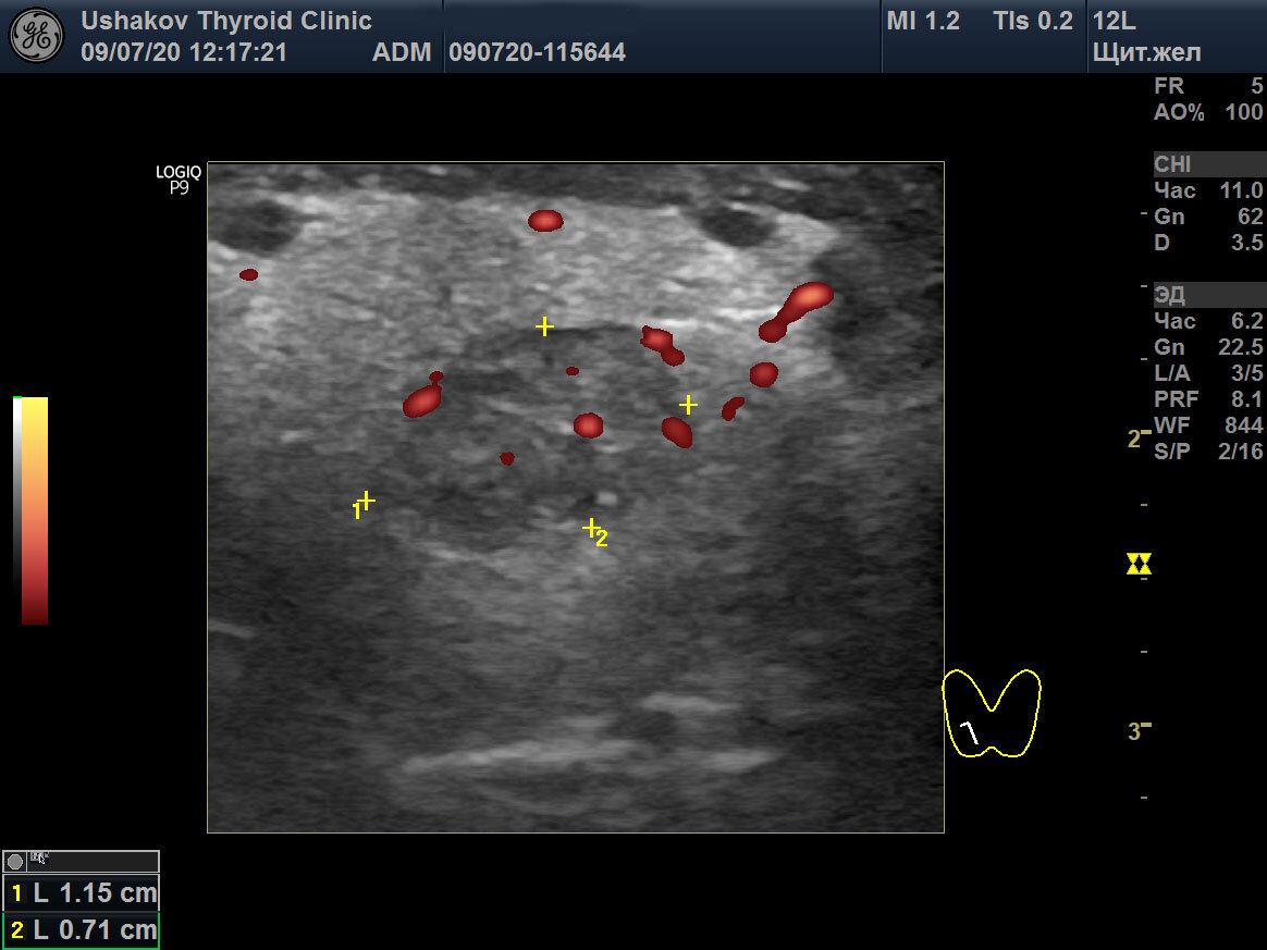 Какое качество УЗИ щитовидной железы в поликлиниках? | Клиника щитовидной  железы | Дзен