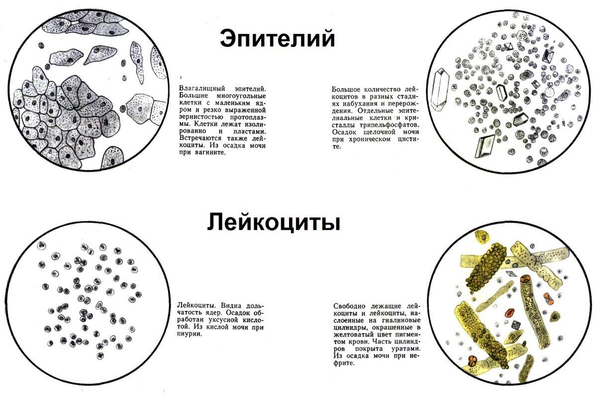Бактерии и белки в моче. Лейкоциты микроскопия в моче норма. Эритроциты в моче микроскопия. Микроскопия мочи лейкоциты и эритроциты. Микроскопия осадка мочи лейкоциты норма.