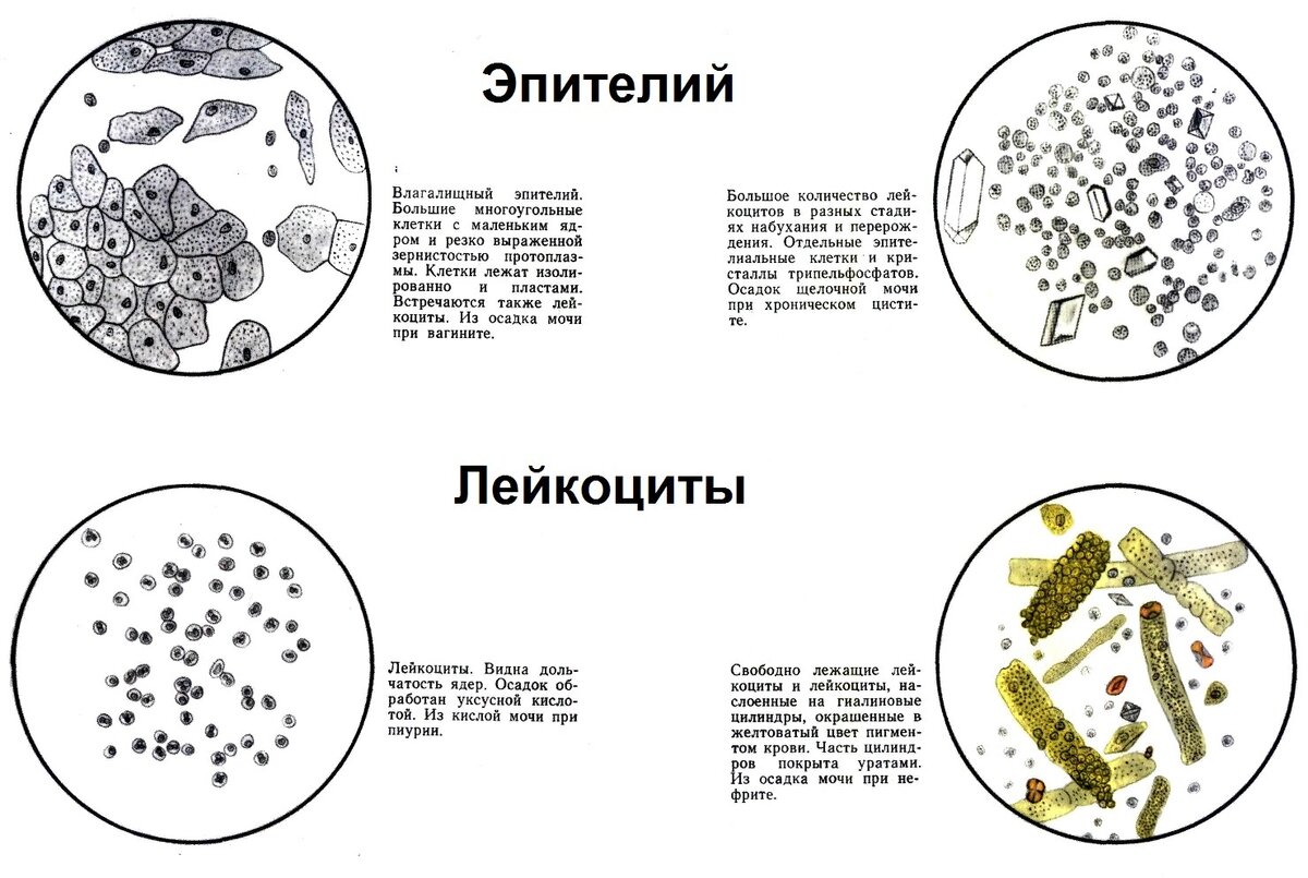 Общий (клинический) анализ мочи - показатели, нормы ОАМ и анализа по Нечипоренко