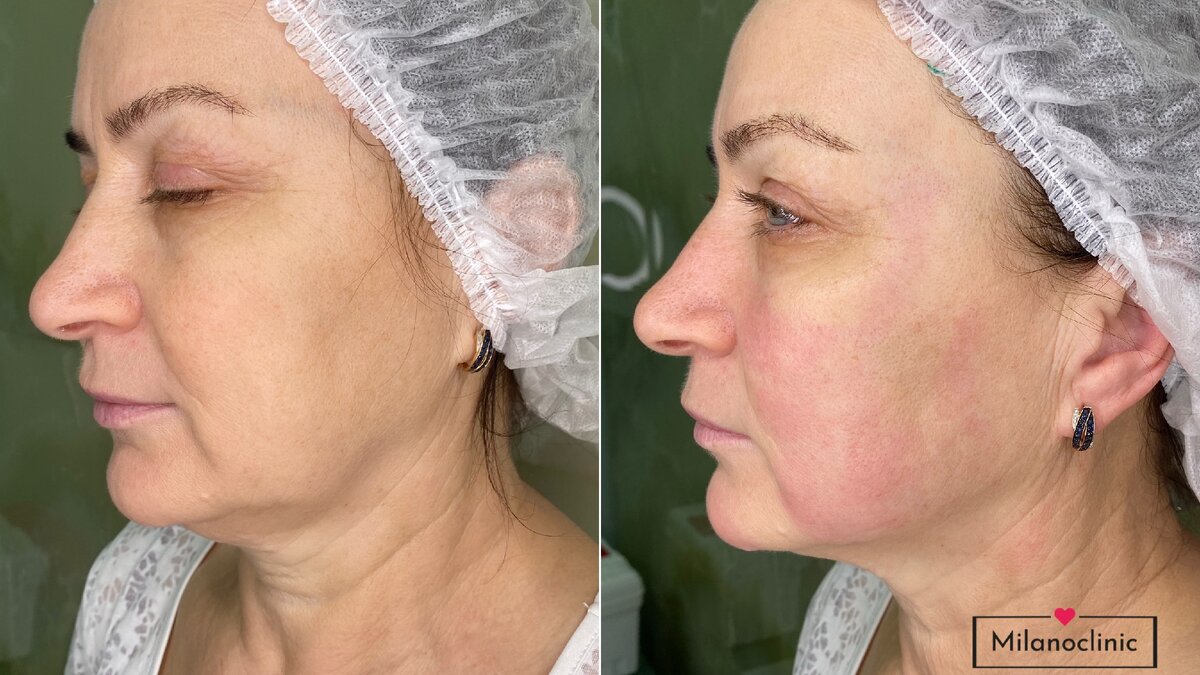 Пациенту 59 лет. Результат СРАЗУ после процедуры SMAS-лифтинга. 