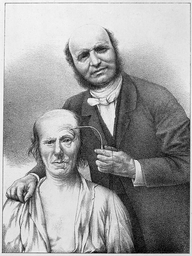 Гийом Бенжамен Арман Дюшенн (17 сентября 1806 — 15 сентября 1875) стимулирует электричеством мимические мышцы подопытного мужчины. Фото с сайта https://commons.wikimedia.org/wiki/File:Duchenne_de_Boulogne,_faradising_the_frontal_muscles_Wellcome_M0011346.jpg 