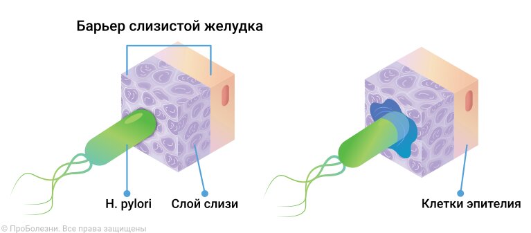 Язвенная болезнь желудка и 12-перстной кишки