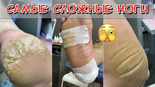 Самые сложные ноги / Кератоз пяток / Огрубевшие пятки / Трещины на пятках / Педикюр