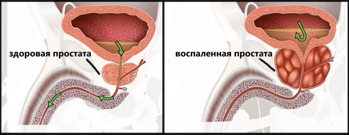 Слева-здоровая простата .Справа-воспаленная простата