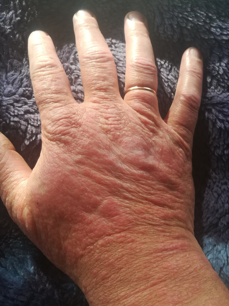 Аллергия на коже.