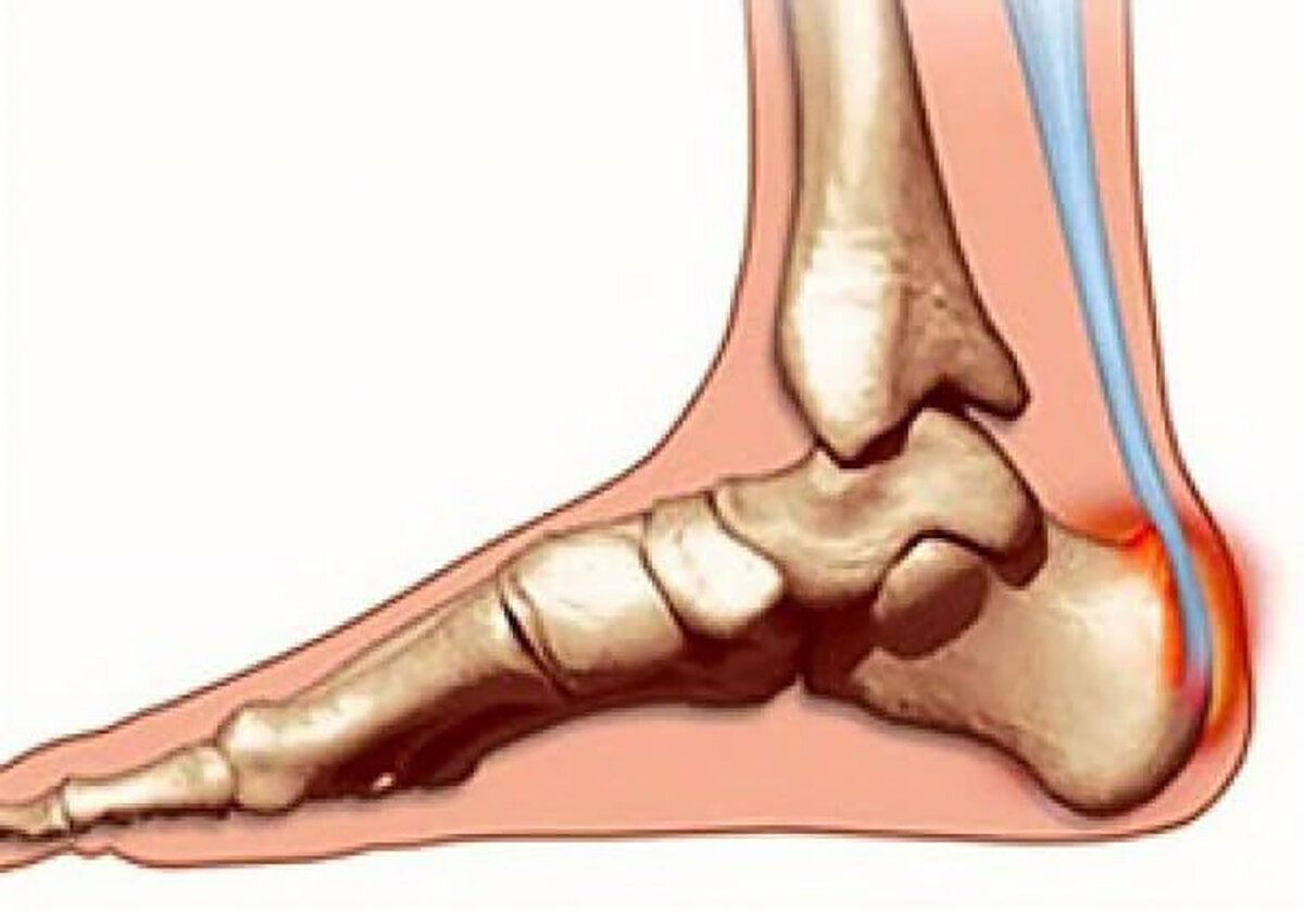 Повреждение ахиллова сухожилия - причины, симптомы, …