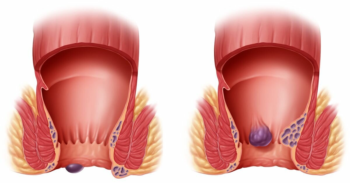 Геморрой