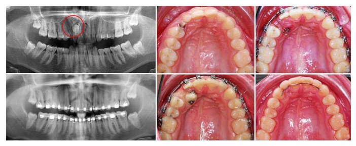 Этапы лечения ретинированного зуба