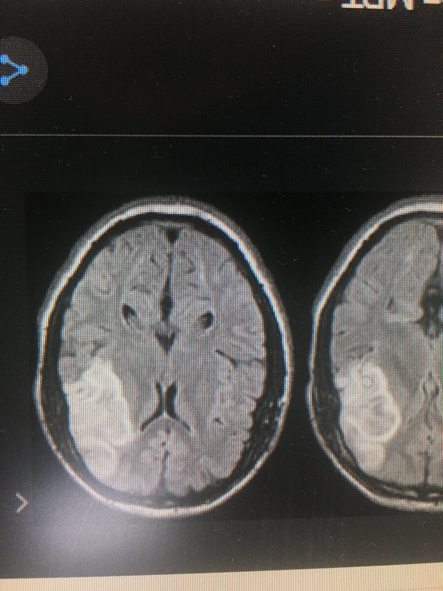 Инсульт на МРТ снимках 