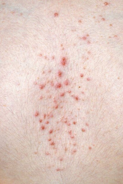 Акнеподобная сыпь