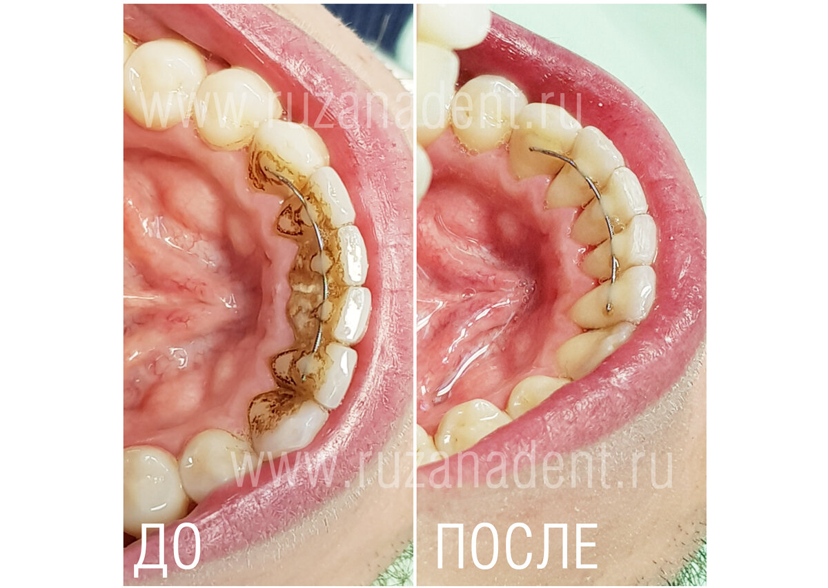 Зубной камень, налет или кариес: в чем отличия?