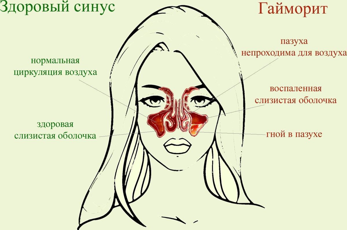 Почему отдает в нос. Строение носа при насморке.