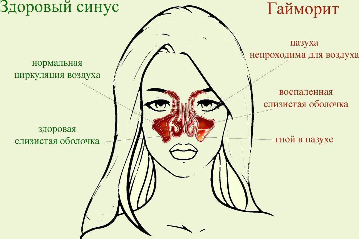 Сколько лечат гайморит. Строение носа при насморке.