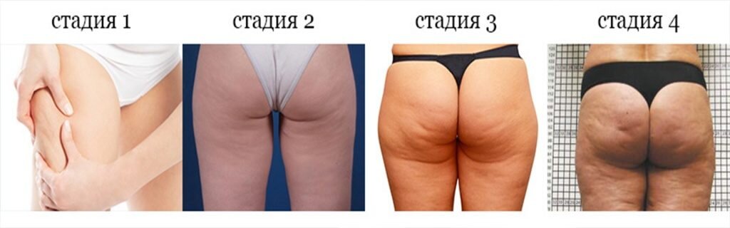 Стадии жира на ногах.