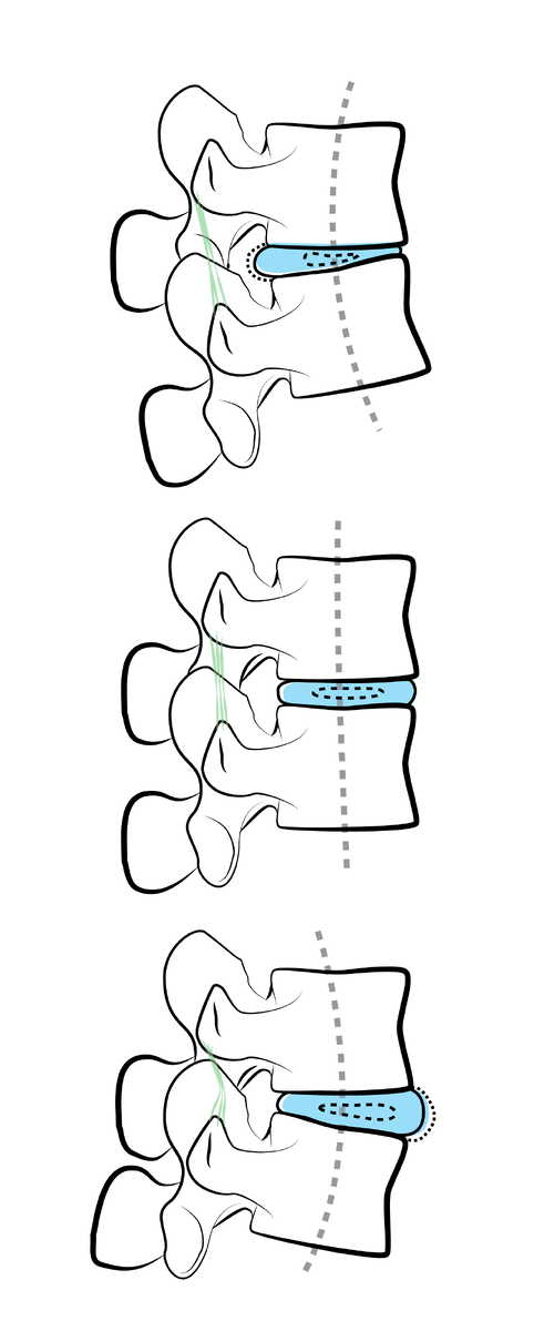 Положения межпозвонкового диска при наклоне, в положении с прямой спиной и при прогибе. © Иллюстрация — Гималайская Академия Йоги, учебное пособие "Азы анатомии и биомеханики" (2016). 