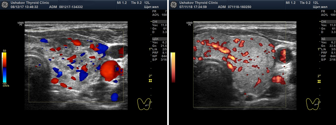 Слева -ЦДК (красные и синие элементы показывают сосуды и направление тока крови). Справа - ЭДК.
