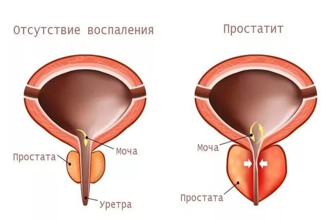 Застойный (конгестивный) простатит