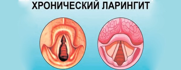 Источник: https://www.lor-moscow.ru/images/laringit_xroniheskii.jpg