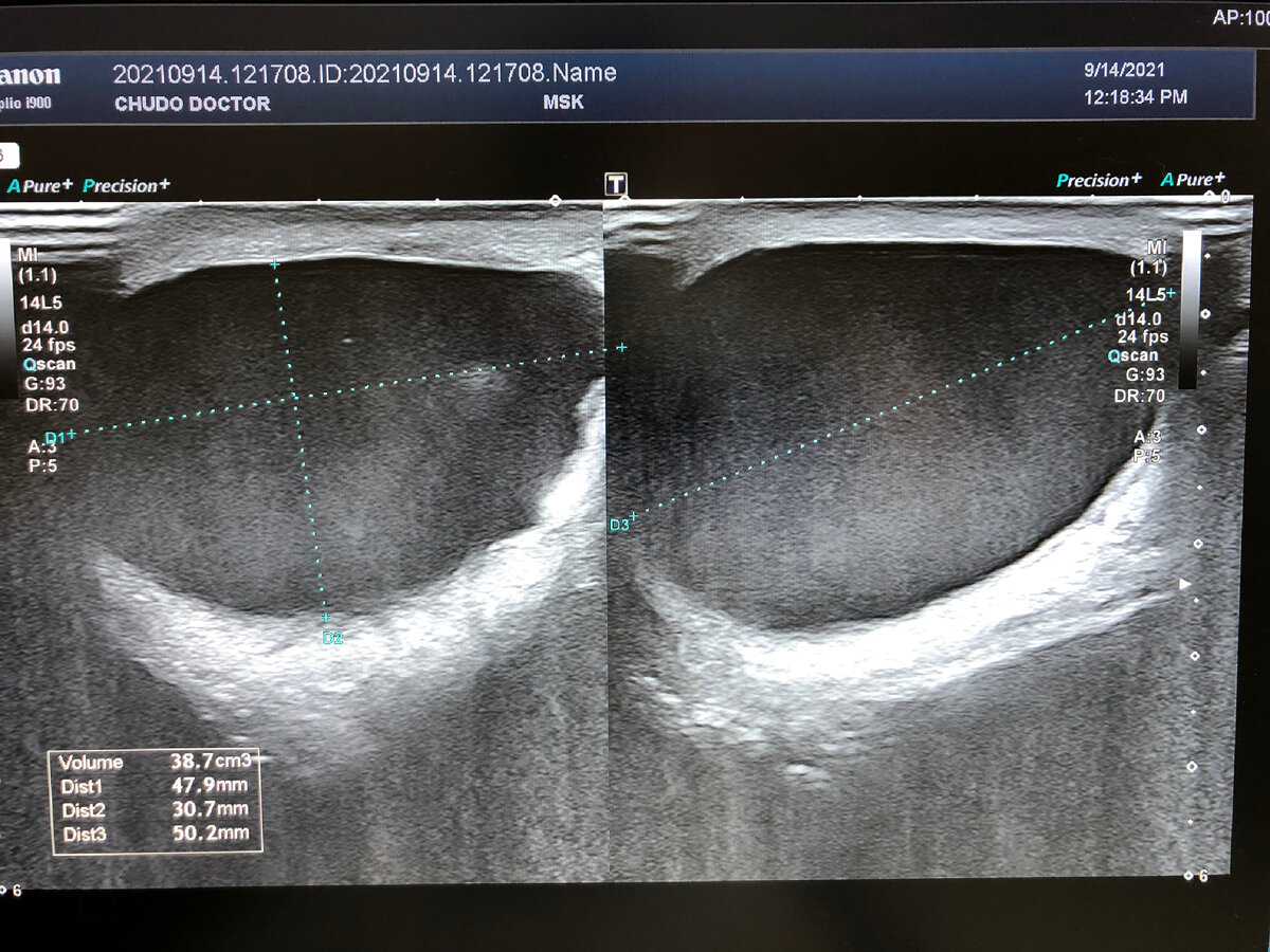 Гидроцеле код. Фибролипома мягких тканей на УЗИ. Киста семенного канатика на УЗИ. Киста семенного канатика УЗИ картина. Киста яичка семенного канатика УЗИ.