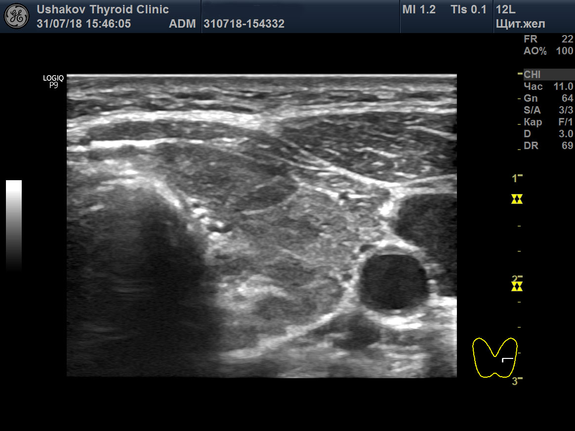 УЗИ ЩЖ в серой шкале. посмотрите - в доле видны деление (белыми линиями) на части - сегменты.