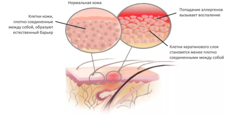 Нейродермит: от диагностики к лечению