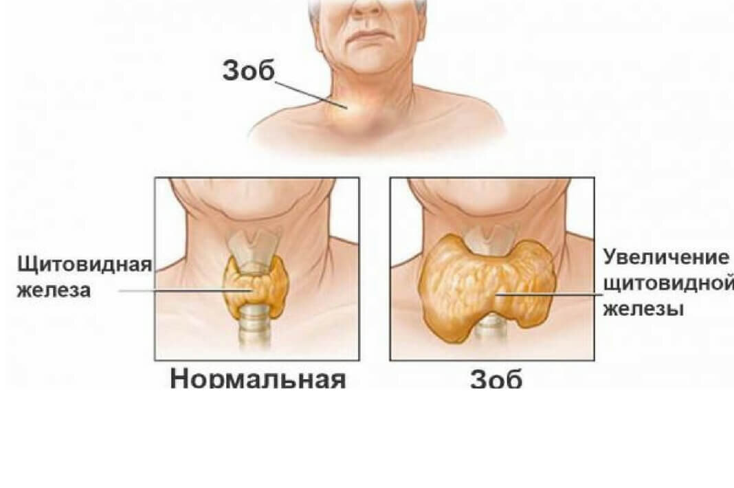 Психосоматика зоб щитовидной железы