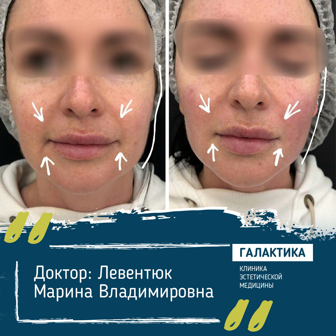 Процедура Forever Young на аппарате Sciton BBL, работа доктора клиники эстетической медицины Галактика - Левентюк Марины Владимировны. До и после процедуры