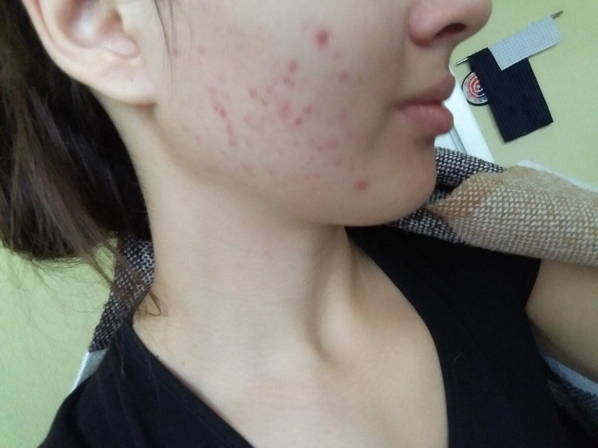 Как раз после диеты. Гормональный сбой и куча проблем 