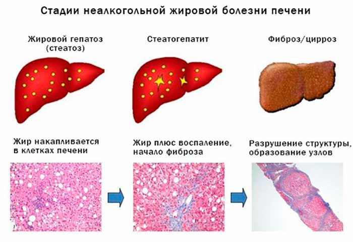 Стадии развития жировой болезни печени