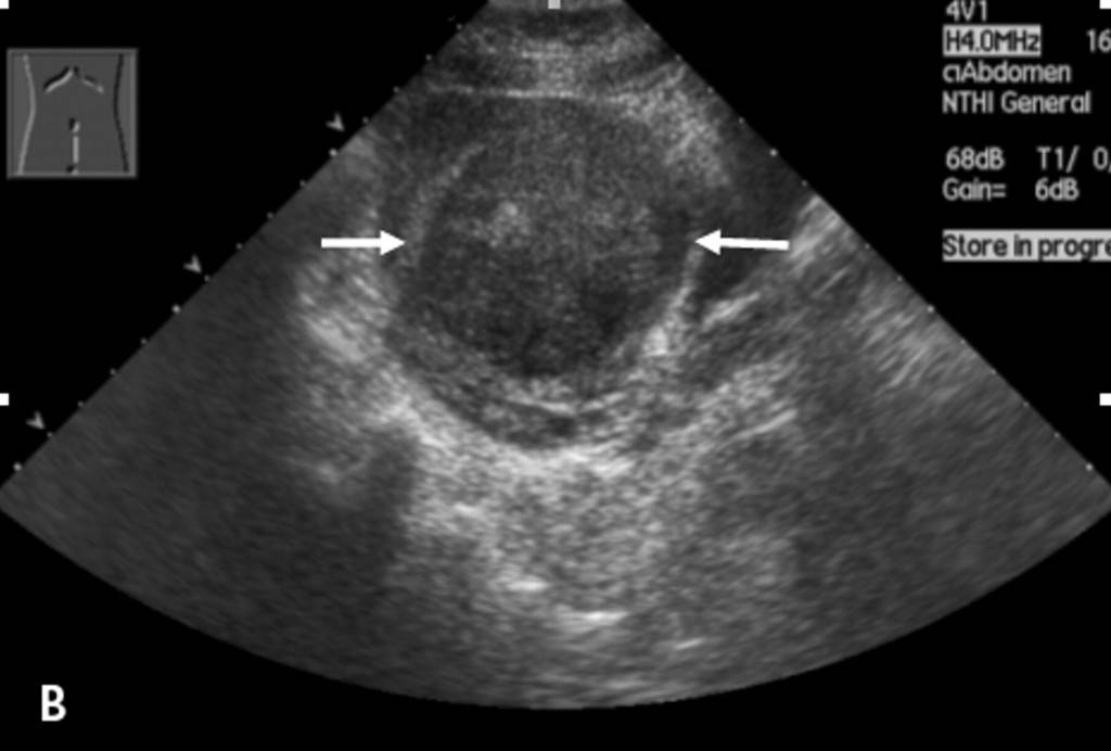 Миома задней стенки на узи