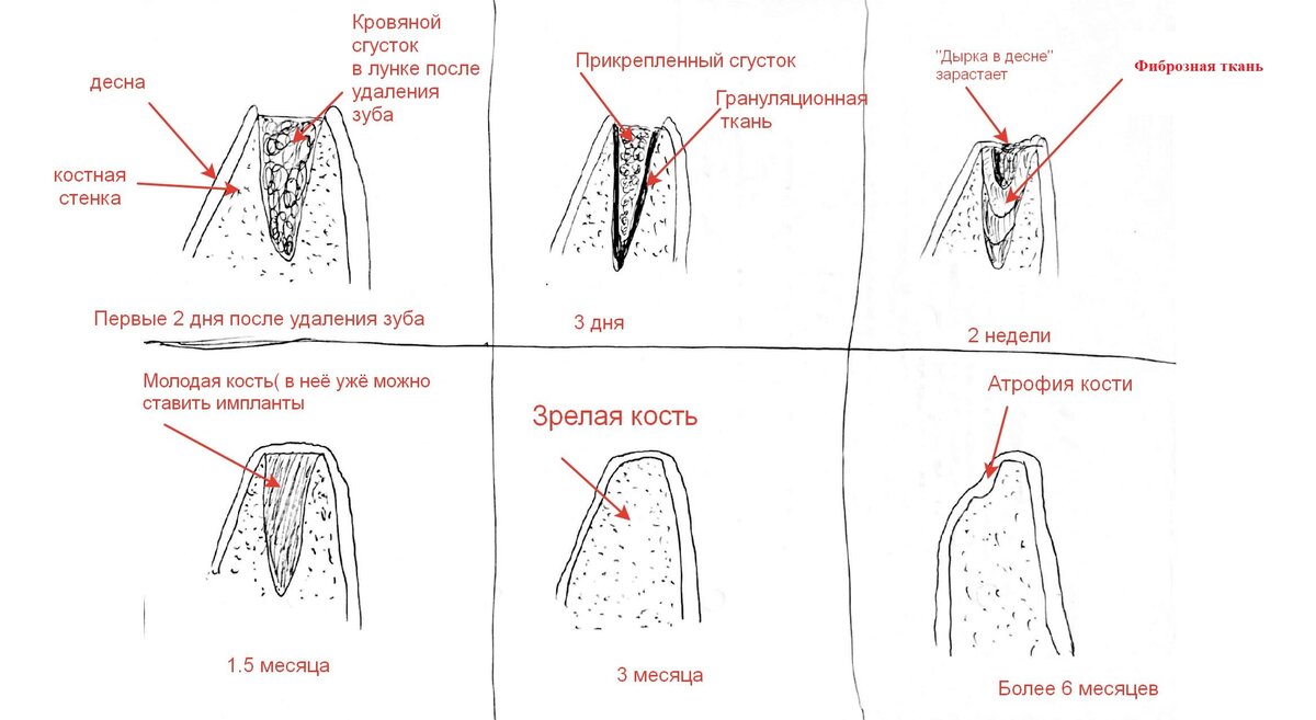 Сага о стоматологии. Глава 14. Когда заживет десна после удаления зуба? |  Твой стоматолог | Дзен