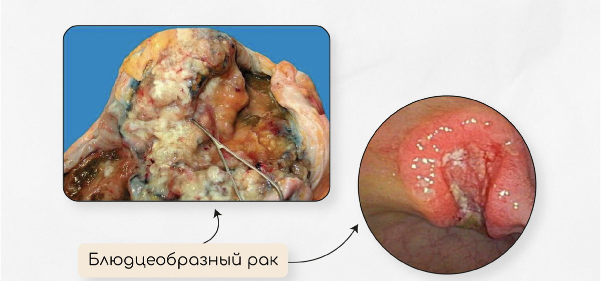 ПАРИЖСКАЯ КЛАССИФИКАЦИЯ ОПУХОЛЕВЫХ ПОРАЖЕНИЙ ЖКТ