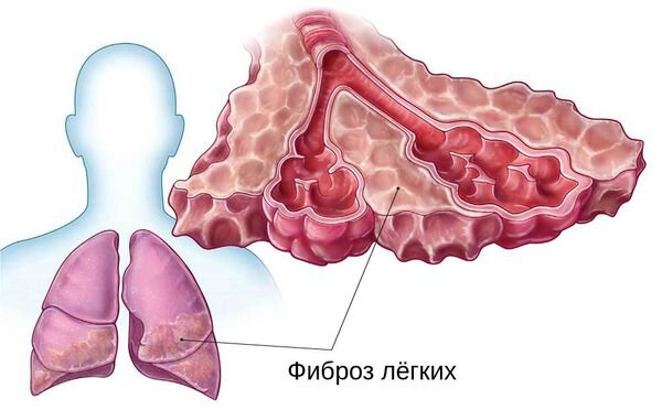 Фиброз легких: симптомы, лечение и профилактика - статья на МЦ «ЛОТОС»